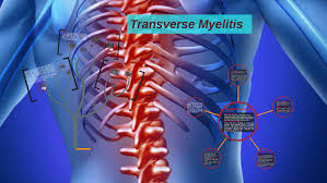 Aufgrund der oft unspezifischen symptome endokriner nebenwirkungen wie müdigkeit, schwächegefühl,. Transverse Myelitis By Chihaya Chan