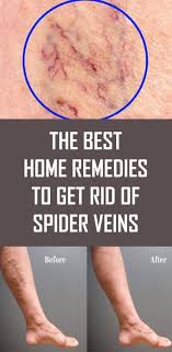 The Best Home Remedies To Get Rid Of Spider Veins Get Rid Of Spider Veins Spider Veins Natural Health Remedies