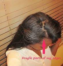 Hair Loss At The Hair Line Part 1 Causes Of Receding Hair Line Rehairducation