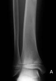 Image result for Osteomyelitis XRay