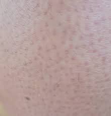 Image result for Keratosis pilaris