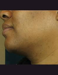 Gray, white, blonde, or red hair cannot be detected by the laser as well. Laser Hair Removal In Gainesville Fl Pure Aesthetics