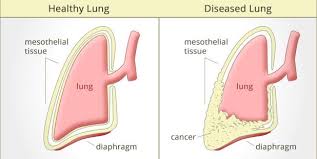 Mesothelioma cancer can be cured. Mesothelioma Cancer Chemotherapy Radiation Therapy Pleural Peritoneal Mesothelioma Cancer Ribbon Colours
