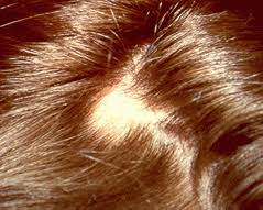 Learn more about the causes alopecia areata is a disease that attacks your hair follicles (the part of your skin that makes hair). Ù…Ø±Ø¶ Ø§Ù„Ø«Ø¹Ù„Ø¨Ø© Ø§Ù„Ø«Ø¹Ù„Ø¨ÙŠØ© Ø§Ù„ØµÙ‚Ø¹ Alopecia Areata ØªØ¹Ø±ÙŠÙ Ø§Ø³Ø¨Ø§Ø¨ Ø§Ù†ÙˆØ§Ø¹ Ø§Ø¹Ø±Ø§Ø¶ Ø¹Ù„Ø§Ø¬ Ø·Ø¨ÙŠØ¨ Ø¯ÙˆØª ÙƒÙˆÙ…