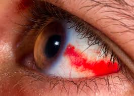 Discover 10 common causes of blood clots at 10faq health and stay better informed to make healthy living decisions. 6 Health Concerns That Your Eyes Could Be Warning You About Health Essentials From Cleveland Clinic