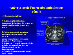 L'aorte abdominale joue un rôle majeur dans la vascularisation de l'organisme grâce à ses l'anévrisme de l'aorte abdominale correspond à sa dilatation, survenant lorsque les parois de le risque d'une telle rupture devient important lorsque le diamètre de l'aorte abdominale dépasse 5 cm. Anevrysmes Aortiques Ppt Video Online Telecharger