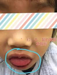 小孩高烧持续不退! 当心川崎病！ Kawasaki Disease ( KD) 到底什么是Kawasaki Disease 川崎病?  为什么川崎病需要及时诊断与治疗？如果没有及时治疗会危险吗??? 1) 什么是川崎病(