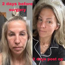 Progress after shoulder surgery recovery at day six