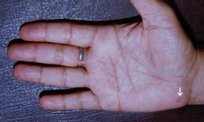 Palmar erythema is rare skin condition that affects the palms and fingers. Palmar Erythema And Hoarseness An Unusual Clinical Presentation Of Sarcoidosis The Medical Journal Of Australia