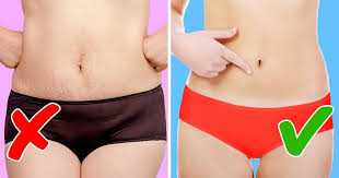 In one clinical study, more than half of testers saw changes to scars after two weeks. 8 Natural Tips To Make Your Stretch Marks Fade