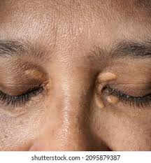 Image result for xantelasma