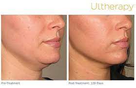 Ultherapy The Only Fda Approved Non Surgical Face Lift Image Magazine