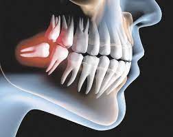 Dente Do Siso Tirar Ou Nao 27 11 13 Viva Com Mais Saude Jornal Cruzeiro Do Sul