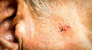 Point out anything you're concerned about to your doctor, including: Types Of Skin Cancer On The Ear