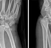 Surgical Treatment for 4 Types of Wrist Fractures