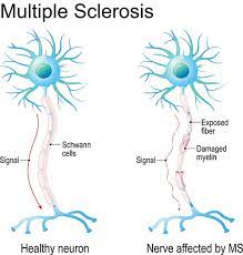 In multiple sclerosis (ms), the immune system attacks and destroys the fatty myelin coating that surrounds and insulates nerve cells in a process known as demyelination. Understanding Multiple Sclerosis Brain Institute Ohsu