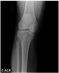Image result for Ballottable Patella Sign