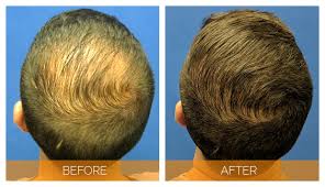 Hair transplant repair procedures rework and address a patient's concern over a prior surgical hair restoration procedure. Memphis Hair Doctor Hair Transplants By Experts