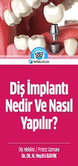 Dis Implanti Nedir Ve Nasil Yapilir Dis Dis Sagligi Saglik