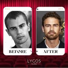 Theo James Hair Transplant