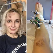 Gemma Smith Talks About Her Accident and Women in Diving