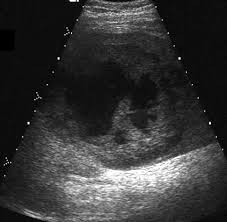 Multiple Lesions Of The Spleen Differential Diagnosis Of Cystic And Solid Lesions Sciencedirect