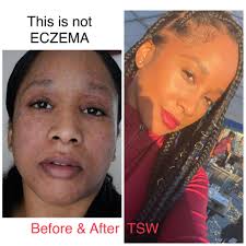 Lea Vasquez shares her Topical Steroid Withdrawal experience : u/Lea_Vasquez