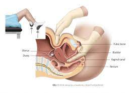 Read below for more related symptoms, causes, and treatment options. Primary Urethral Cancer Patient Information
