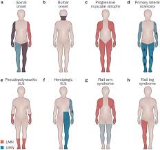 Over time, the loss of muscle control becomes. The Phenotypic Variability Of Amyotrophic Lateral Sclerosis Nature Reviews Neurology