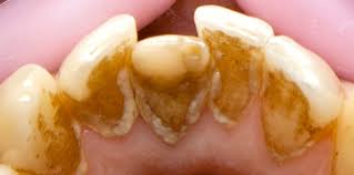 Metoprolol tartrate is used to treat angina (chest pain) and hypertension (high blood pressure).it is also used to lower your risk of death or needing to be hospitalized for heart failure. Tartre Dr Vibert Chirurgien Dentiste A Lyon