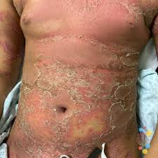 Image result for psoriasis