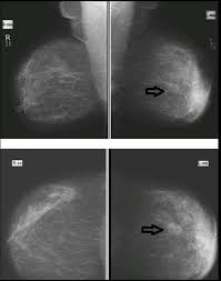 It can also be used to investigate the cause of breast problems, such as a breast mass, pain and nipple. Cureus Diagnostic Accuracy Of Digital Mammography In The Detection Of Breast Cancer