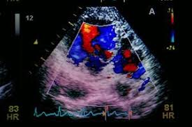 Alles über die symptome, diagnose und behandlung. Was Ist Herzmuskelentzundung Ursachen Symptome Behandlung Krank De