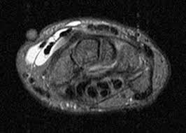 Image result for Intersection Syndrome