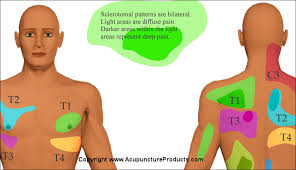 Color Sclerotome Visceral Pain Referral Poster