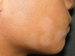 Extensive pityriasis alba has a widespread and symmetrical involvement of the skin. Ein Uberblick Uber Pityriasis Alba