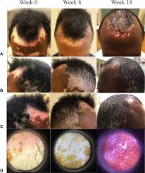 Dr mahendra arogya sansthan is one of the best ayurveda panchkarma center in india for best safe effective scientific treatment of vitiligo (सफ़ेद दाग). Platelet Rich Plasma A Promising Adjunctive Treatment For Vitiligo A Case Report Jaad Case Reports