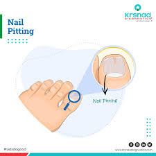 Image result for Pitting nails feet