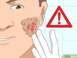 Repeat again for another 10 minutes. 3 Ways To Remove An Ingrown Hair Wikihow