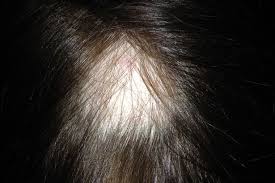 We did not find results for: Thinning Locks And Bald Patches The Hidden Horrors Of Female Hair Loss And How To Fix It Mirror Online