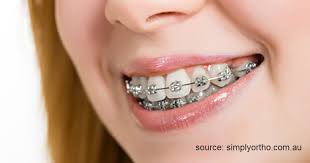 Maybe you would like to learn more about one of these? Jenis Jenis Behel Yang Sering Dipakai Beserta Biaya Pemasangannya