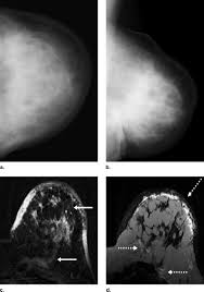 Ibc skin thickening and diffuse tumor areas are more easily visualized by mri. Inflammatory Breast Carcinoma In Magnetic Resonance Imaging Academic Radiology