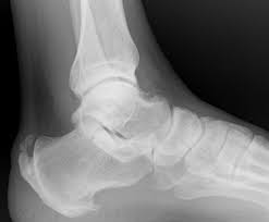 Haglund's deformity is an abnormality of the foot. Haglund S Deformity