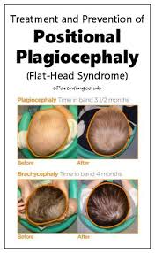 Image result for Positional Head Deformity