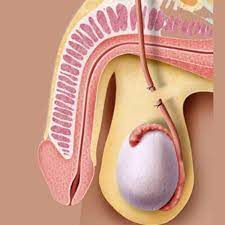 Infection of the surgery site 5. Homens Que Fizeram Vasectomia Ainda Podem Ser Pais