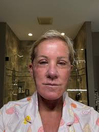 72 hours post op lower face lift and C02 laser