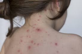 There is no cure, but a vaccine is. Benarkah Kita Tidak Boleh Kena Angin Saat Cacar Air