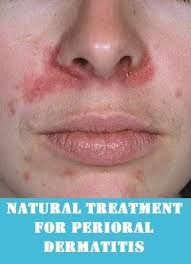 Remedies To Get Rid Of Perioral Dermatitis Perioral Dermatitis Treatment Perioral Dermatitis Perioral