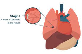 Mesothelioma is an aggressive cancer caused by asbestos exposure. Mesothelioma Cancer Alliance Scholarship Wild Country Fine Arts