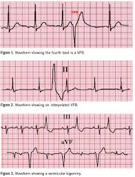 Evaluation And Management Of Ventricular Premature Beats Consultant360
